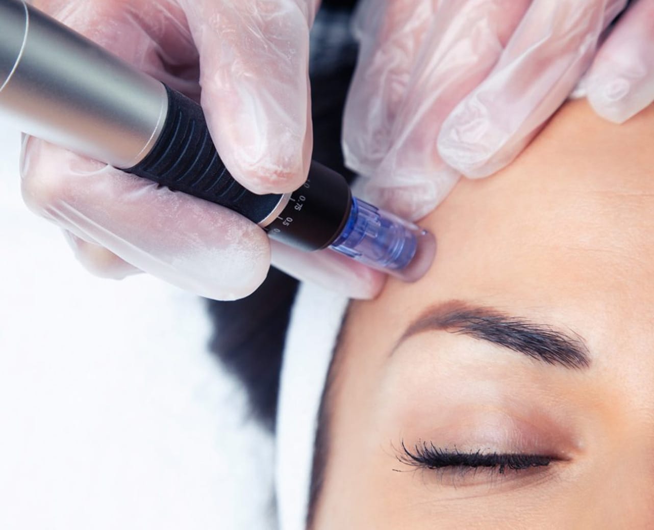 Close-up of a woman getting Microneedling treatment | Aesthetic Center of Richmond in Glen Allen, VA